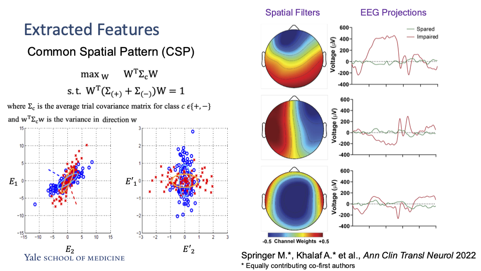A slide shows how brain wave data is mathematically separated into patterns that help distinguish between seizures that impair consciousness and those that do not.